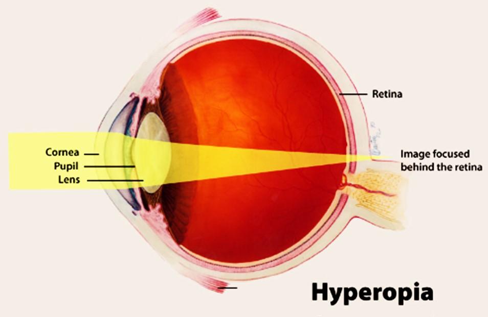 hypermetropia